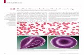 The eff ect of iron overload on red blood cell morphology