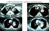 Left  subclavian  artery aneurysm
