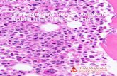 BONE MARROW TRANSPLANTATION (BMT) in β-thalassaemia · This leaflet contains important information for β-thalassaemia patients on hematopoietic stem cell transplantation (HSCT),